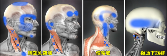 頭痛のトリガーポイント図