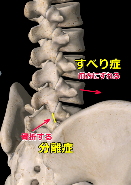 腰椎分離症すべり症図