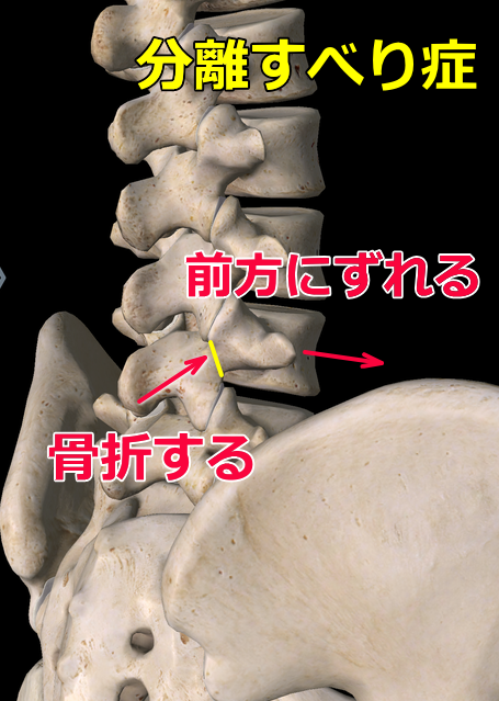 腰椎分離すべり症の画像