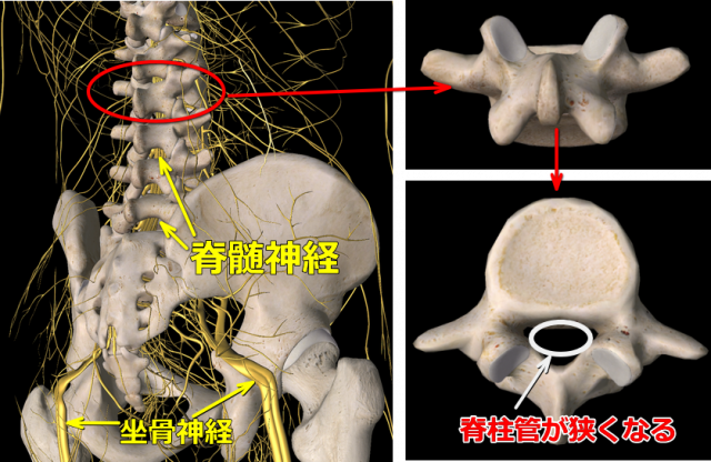 腰椎狭窄症図