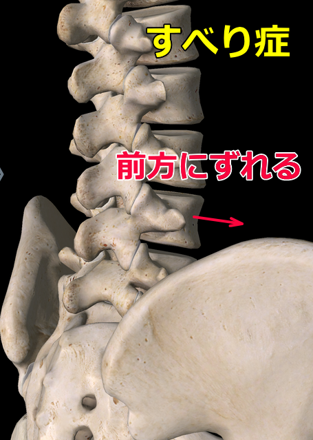 腰椎すべり症の画像