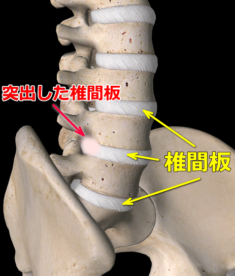 腰椎椎間板ヘルニアの画像