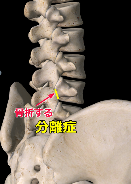 腰椎分離症の画像